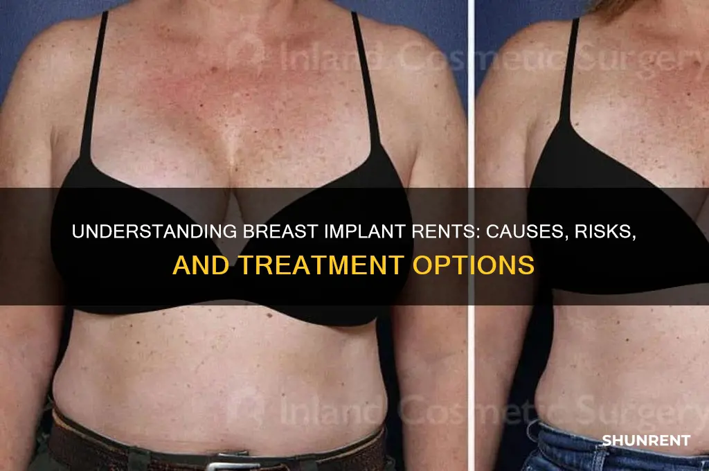 what is a rent in a breast implant