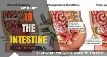 Understanding Intestinal Rent: Causes, Symptoms, and Treatment Options