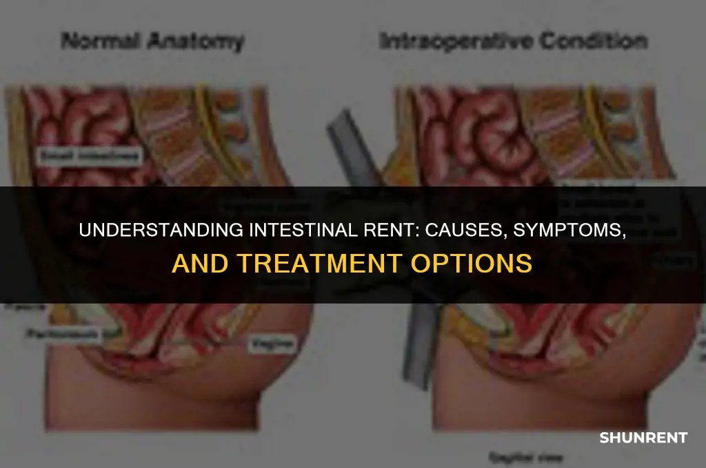 what is a rent in the intestine