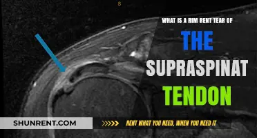 Understanding Rim Rent Tear: Supraspinatus Tendon Injury Explained