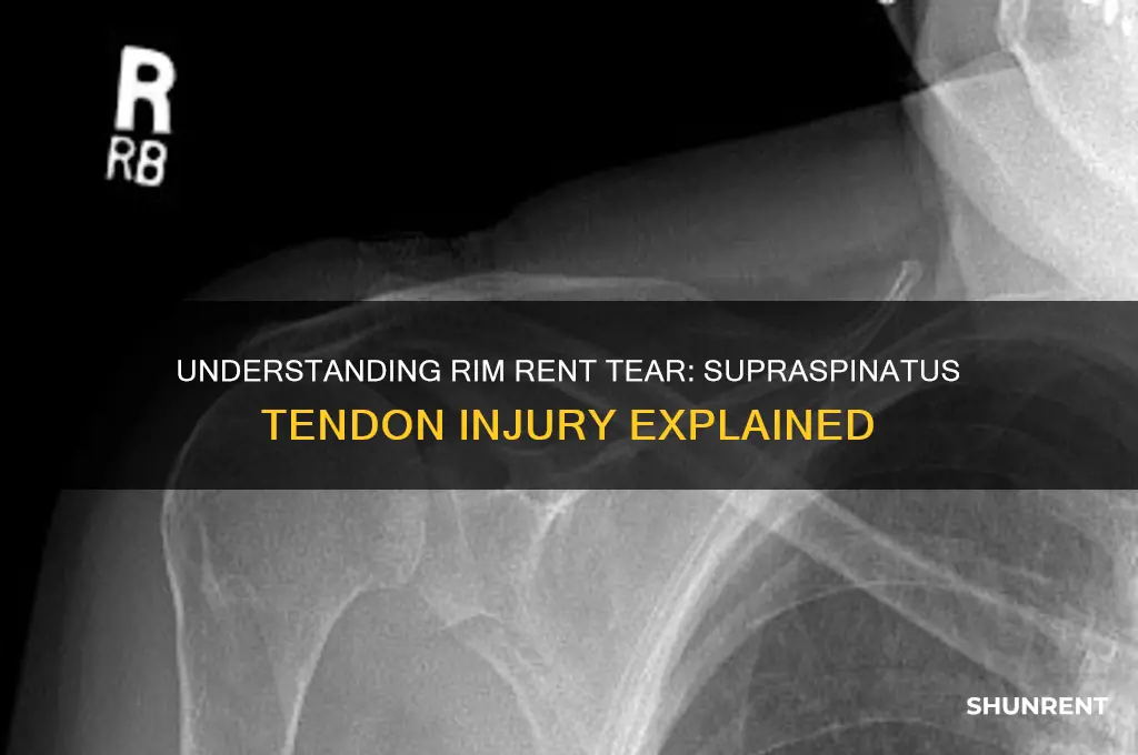 what is a rim rent tear of the supraspinatus tendon